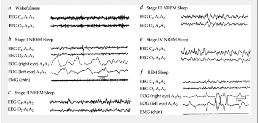 ( Sleep Stages by EEG-EOG-EMG - Image Courtesy of universitipetronas.hostoi.com )