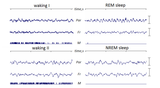 (EEG of REM sleep and NREM sleep - Image Courtesy of commons.wikimedia.org)
