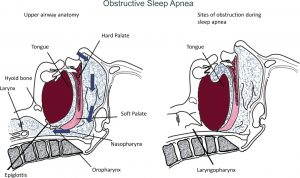 ( Upper Airway Obstruction in OSAS - Image Courtesy of advan.physiology.org )
