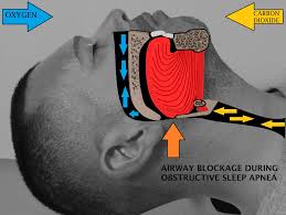 ( OSAS Upper Airway Obstruction - Image Courtesy of en.wikipedia.org )