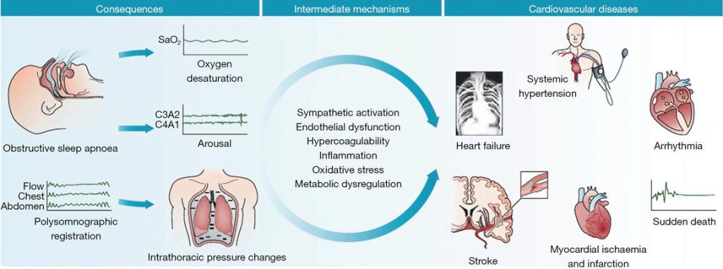 identifying-your-sleeping-disorder-osas-obstructive-sleep-apnea