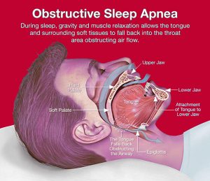 ( OSAS and Upper Airways - Image Courtesy of obstructive-sleep-apnea.info )
