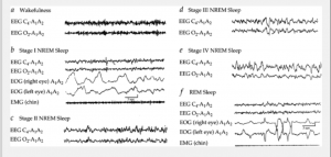 ( Sleep Stages by EEG-EOG-EMG - Image Courtesy of universitipetronas.hostoi.com )