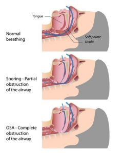 ( Obstructive Sleep Apnea OSAS and Upper Airways in Respiratory Tract - Image Courtesy of www.docsopinion.com )