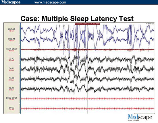 ( MSLT Multiple Sleep Latency Test - Image Courtesy of www.medscape.com )