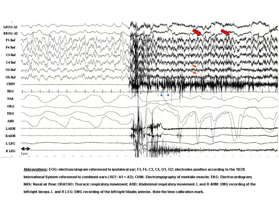 ( Polysomnograph Sleep Analysis Test of Somnambulism - Image Courtesy of raycomgroup.worldnow.com )
