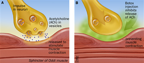 ( Acetylcholine and Muscle Paralysis Mechanism - Image Courtesy of www.gainesonbrains.com )
